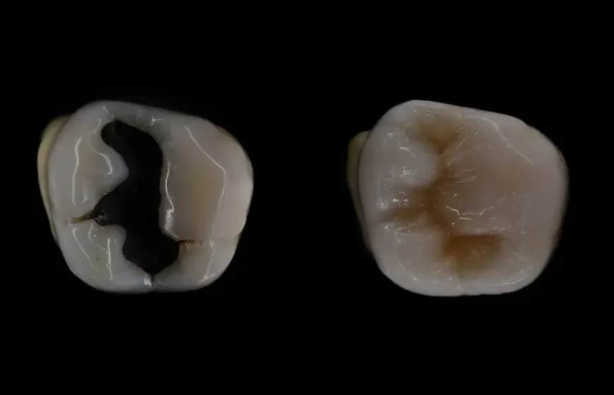 Jakie plomby na NFZ są dostępne? Sprawdź, co możesz wybrać