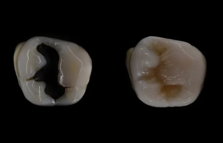 Jakie plomby na NFZ są dostępne? Sprawdź, co możesz wybrać