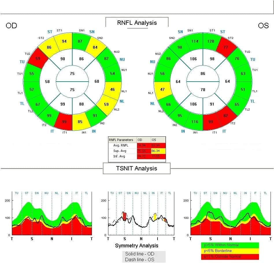 Jak odczytać wyniki badania OCT: proste wskazówki i porady