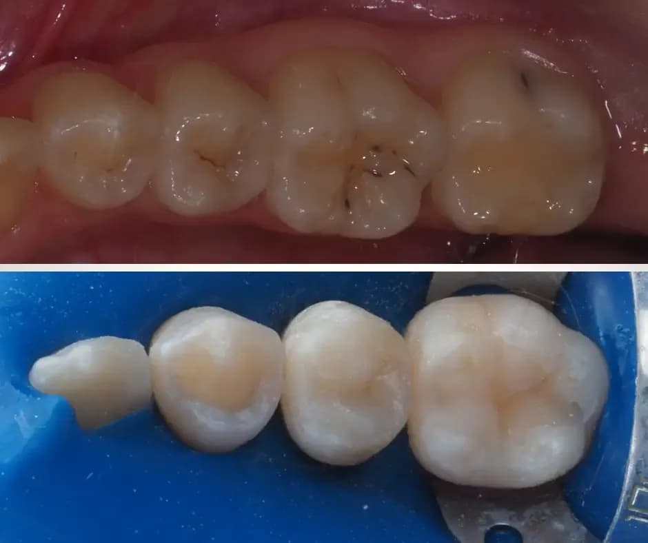 Ile kosztuje biała plomba na NFZ? Sprawdź, co może Cię zaskoczyć