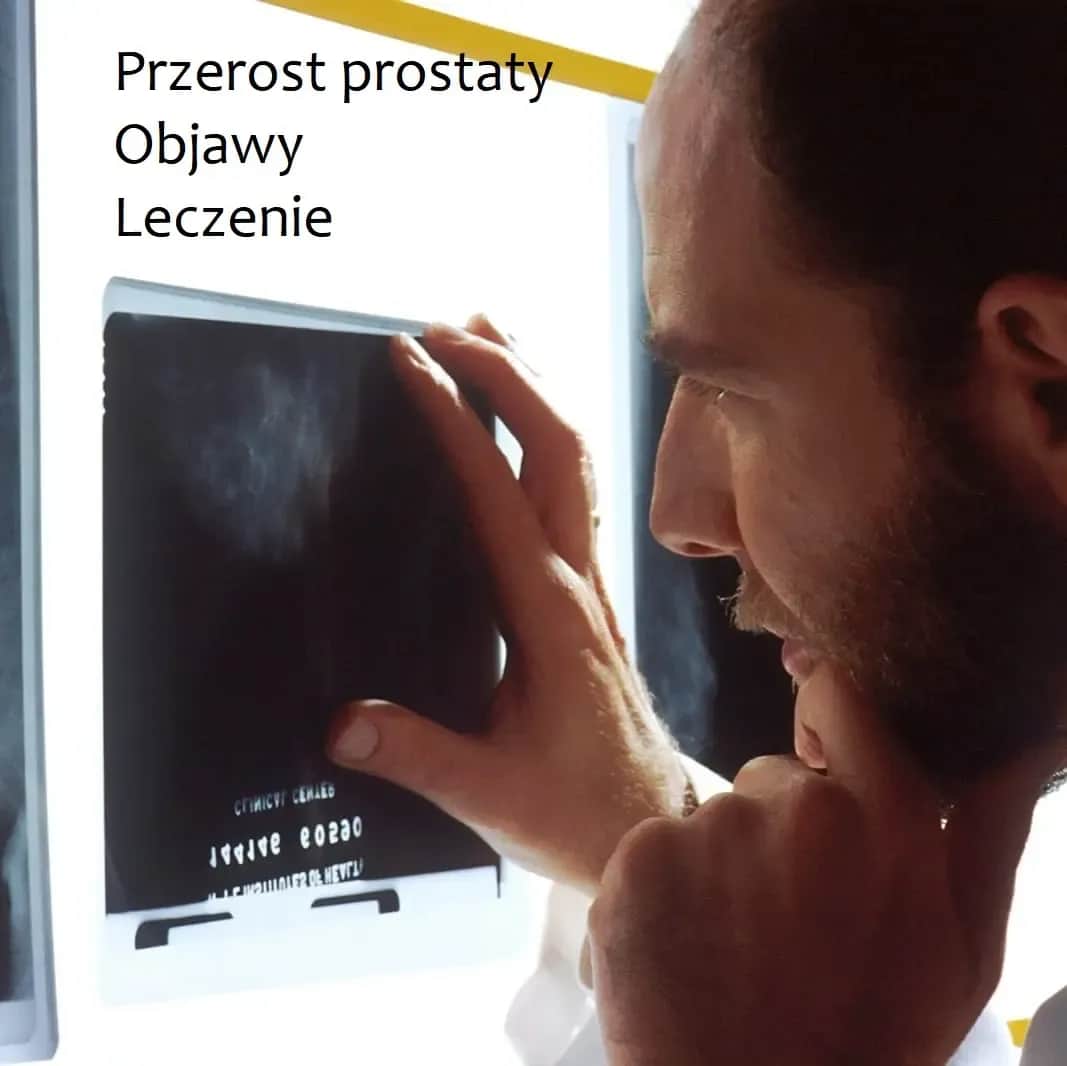 Jak leczyć przerost prostaty? Skuteczne metody i porady dla pacjentów