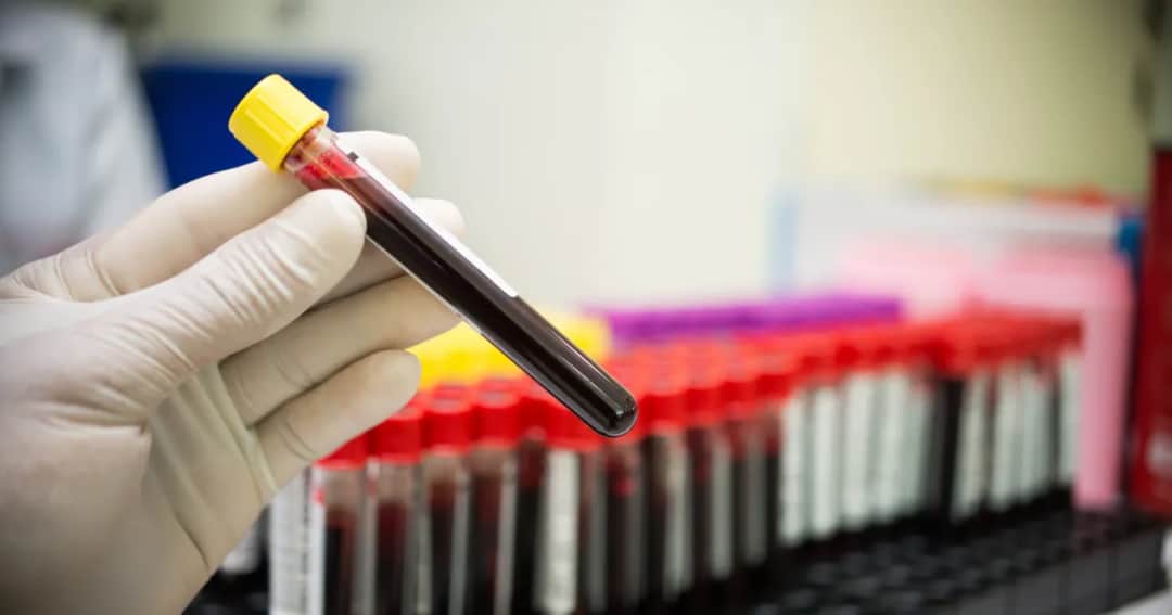 Próby wątrobowe - jak wygląda badanie i co musisz wiedzieć