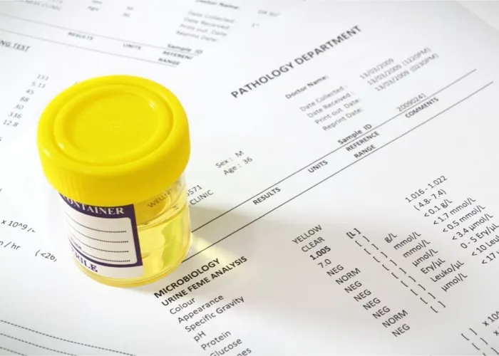 Czy w badaniu moczu wyjdzie nikotyna? Oto co musisz wiedzieć