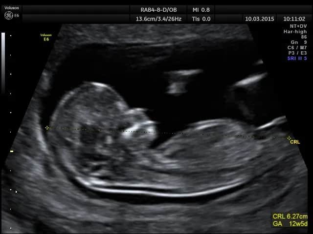 Pierwsze badanie prenatalne dopochwowo czy przez brzuch - co wybrać?