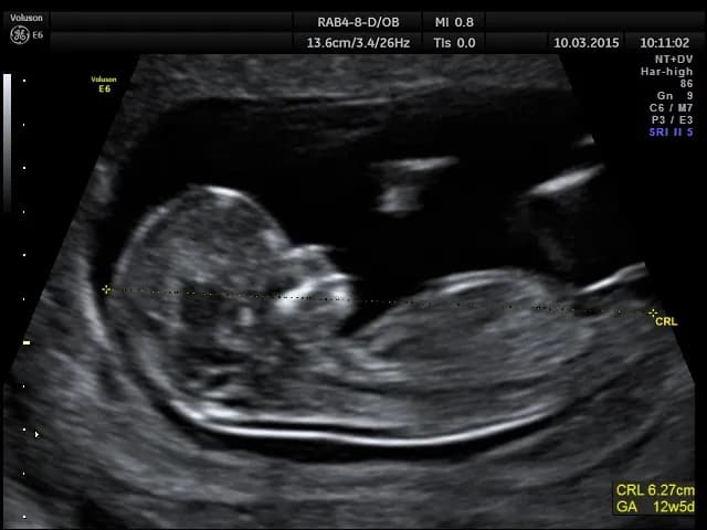 Pierwsze badanie prenatalne dopochwowo czy przez brzuch - co wybrać?