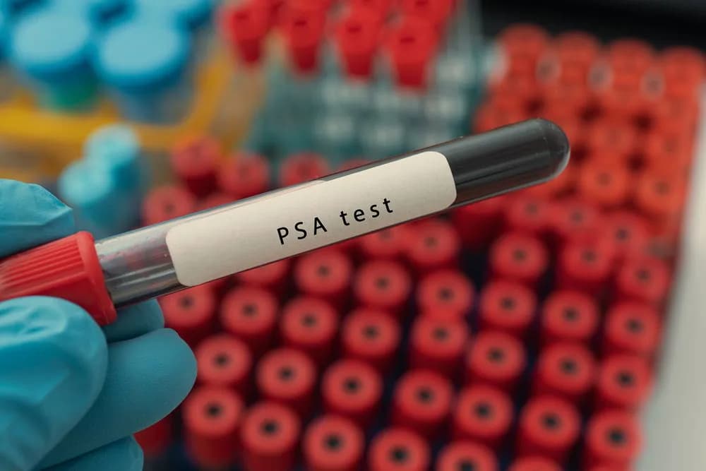 Badanie PSA co to jest i dlaczego może uratować Twoje zdrowie