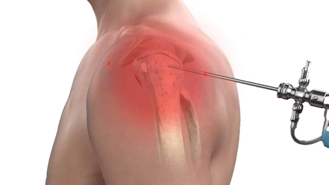 Artroskopia barku NFZ gdzie najszybciej? Sprawdź najlepsze miejsca